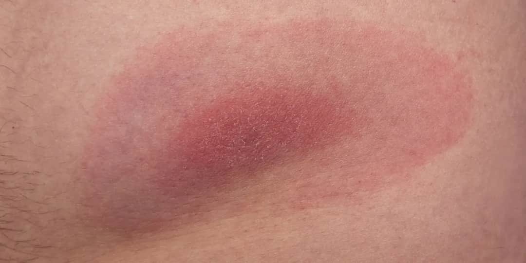 Czym smarować miejsce po kleszczu, aby uniknąć zakażenia?