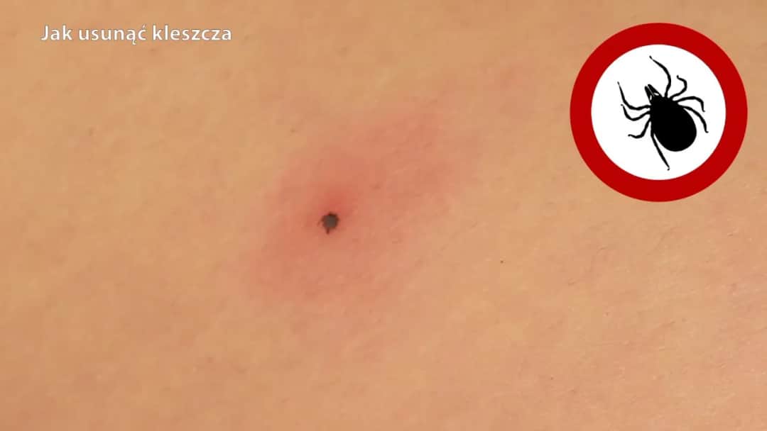 Jak wygląda mały kleszcz? Rozpoznaj go i uniknij niebezpieczeństwa!